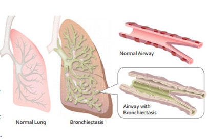 Giãn phế quản - Hình ảnh minh họa